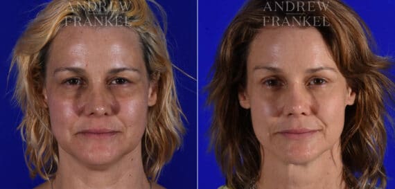 Brow Lift before and after photos in Beverly Hills, CA, Patient 21883
