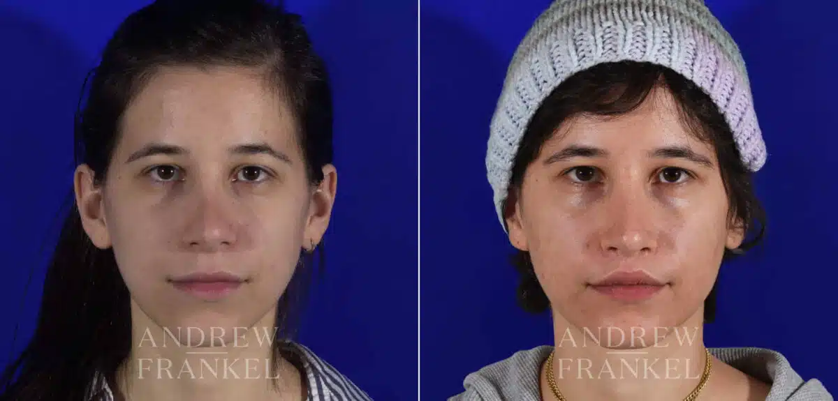 Revision Rhinoplasty before and after photos in Beverly Hills, CA, Patient 22231