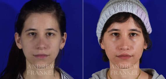Revision Rhinoplasty before and after photos in Beverly Hills, CA, Patient 22231