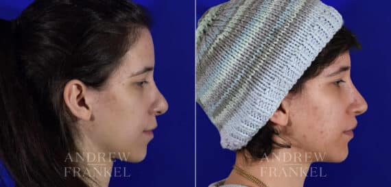 Revision Rhinoplasty before and after photos in Beverly Hills, CA, Patient 22231
