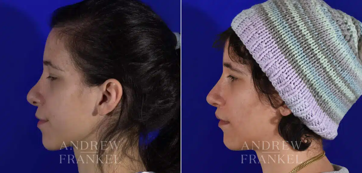 Revision Rhinoplasty before and after photos in Beverly Hills, CA, Patient 22231