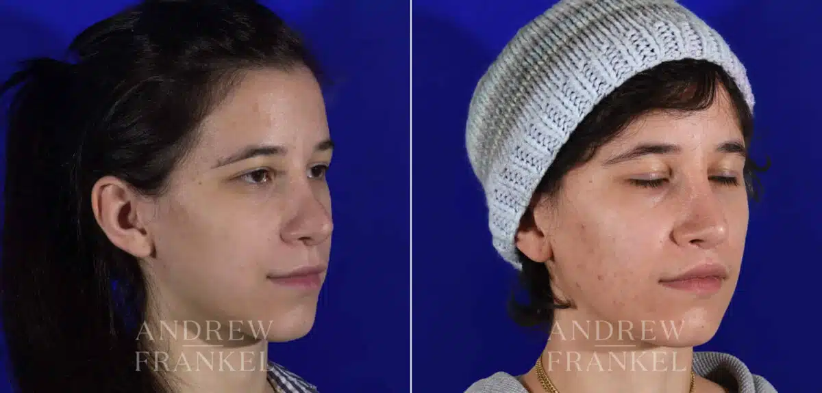 Revision Rhinoplasty before and after photos in Beverly Hills, CA, Patient 22231