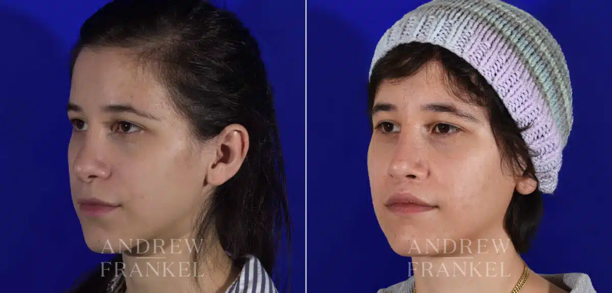 Revision Rhinoplasty before and after photos in Beverly Hills, CA, Patient 22231