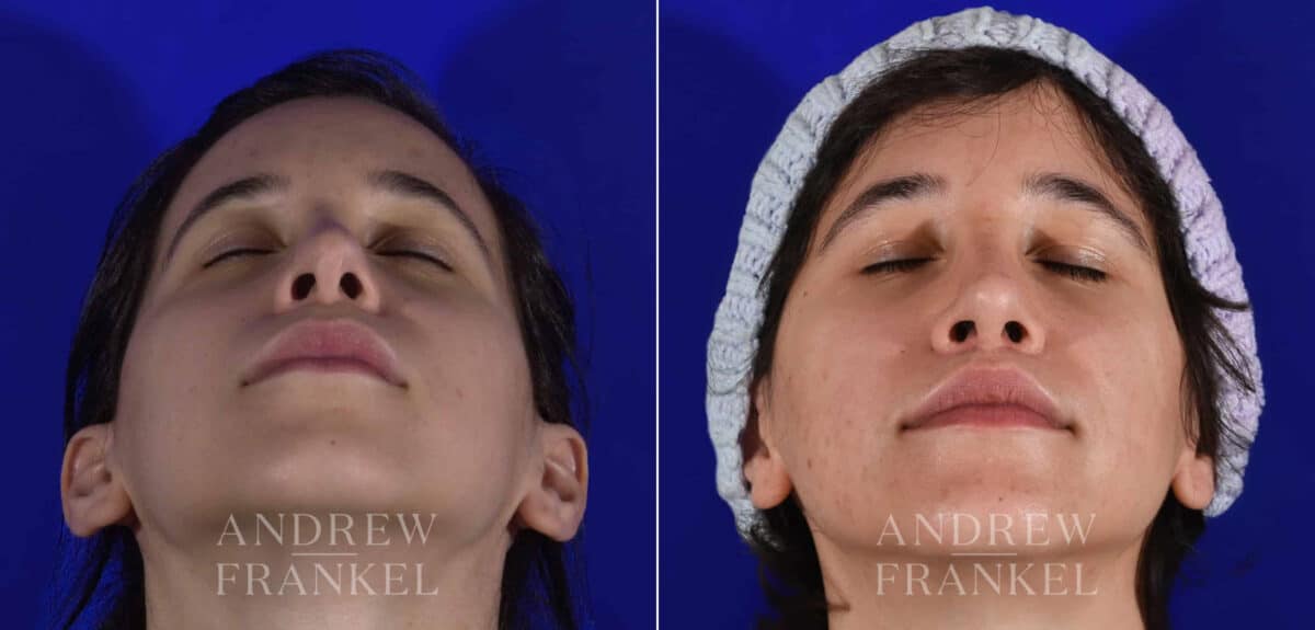 Revision Rhinoplasty before and after photos in Beverly Hills, CA, Patient 22231