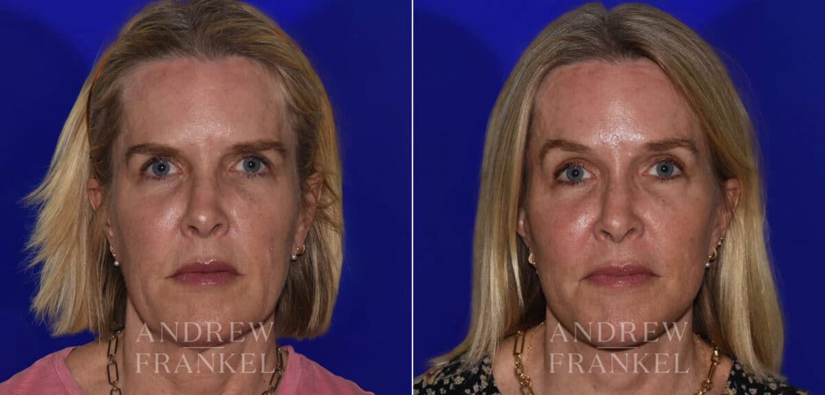 Facial Rejuvenation before and after photos in Beverly Hills, CA, Patient 22361