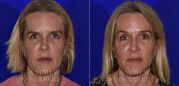 Facial Rejuvenation before and after photos in Beverly Hills, CA, Patient 22361