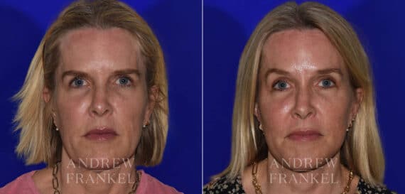Facial Rejuvenation before and after photos in Beverly Hills, CA, Patient 22361