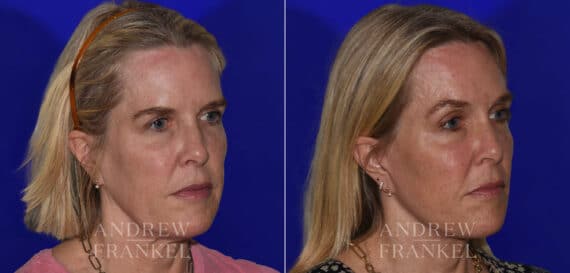 Facial Rejuvenation before and after photos in Beverly Hills, CA, Patient 22361