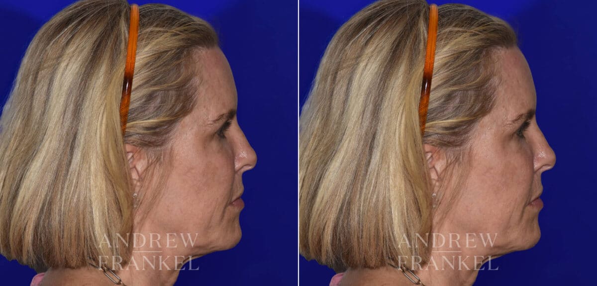 Facial Rejuvenation before and after photos in Beverly Hills, CA, Patient 22361