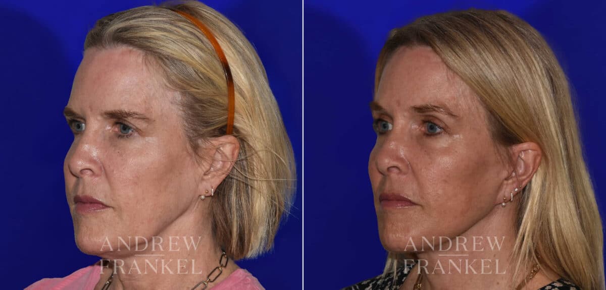 Facial Rejuvenation before and after photos in Beverly Hills, CA, Patient 22361