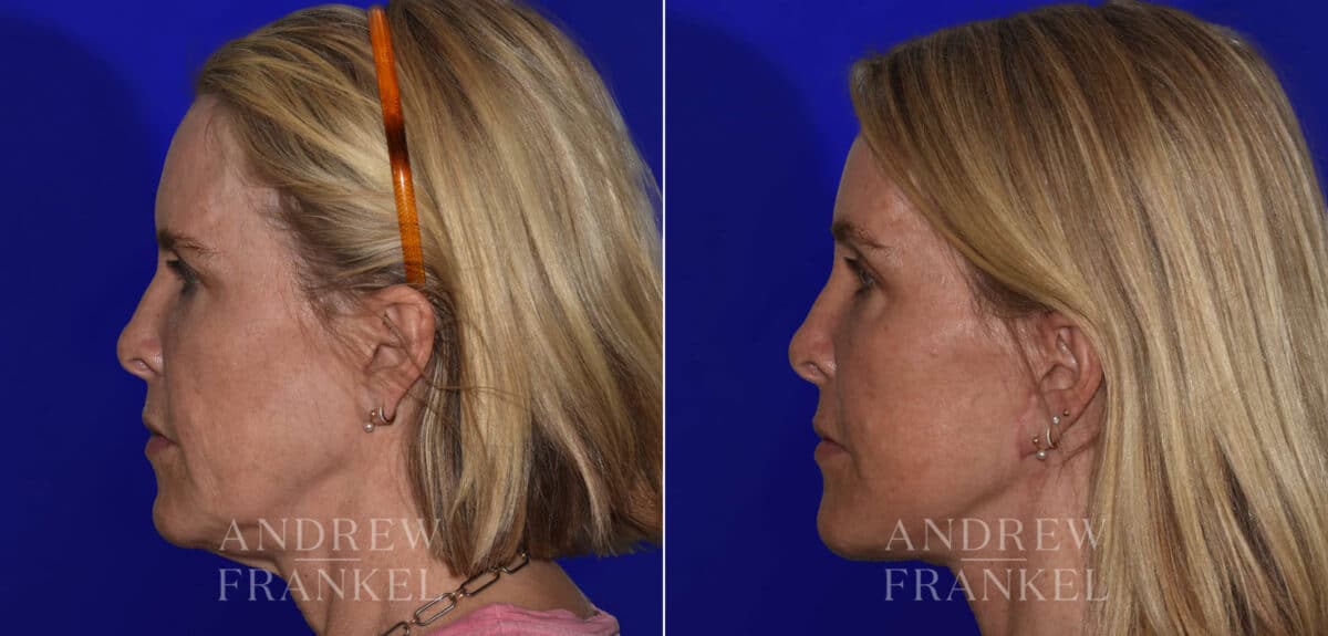 Facial Rejuvenation before and after photos in Beverly Hills, CA, Patient 22361