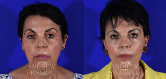 Facial Rejuvenation before and after photos in Beverly Hills, CA, Patient 22377