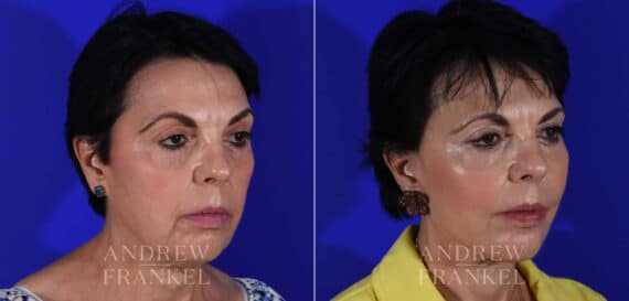 Facial Rejuvenation before and after photos in Beverly Hills, CA, Patient 22377