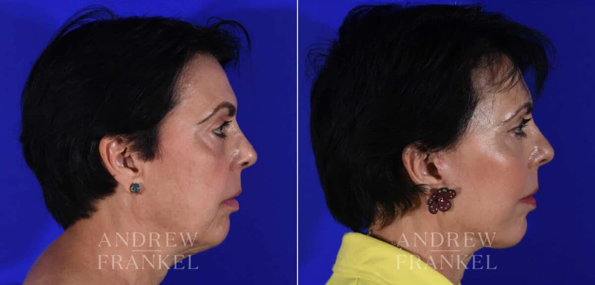 Facial Rejuvenation before and after photos in Beverly Hills, CA, Patient 22377