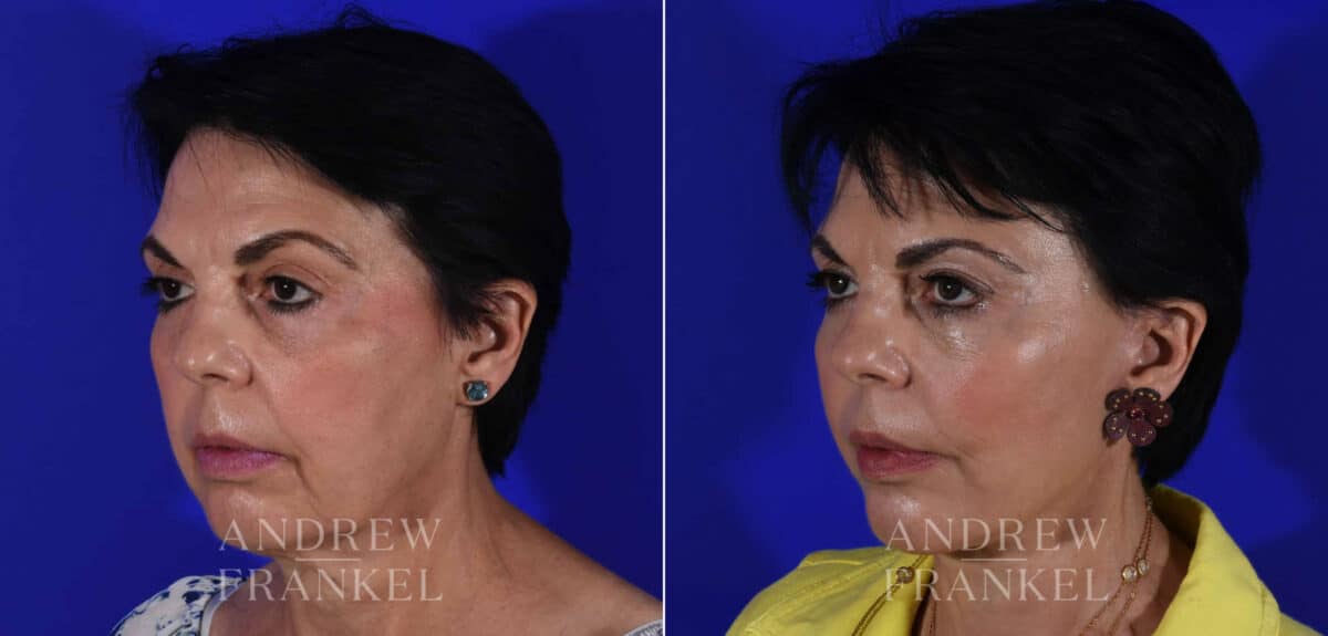 Facial Rejuvenation before and after photos in Beverly Hills, CA, Patient 22377