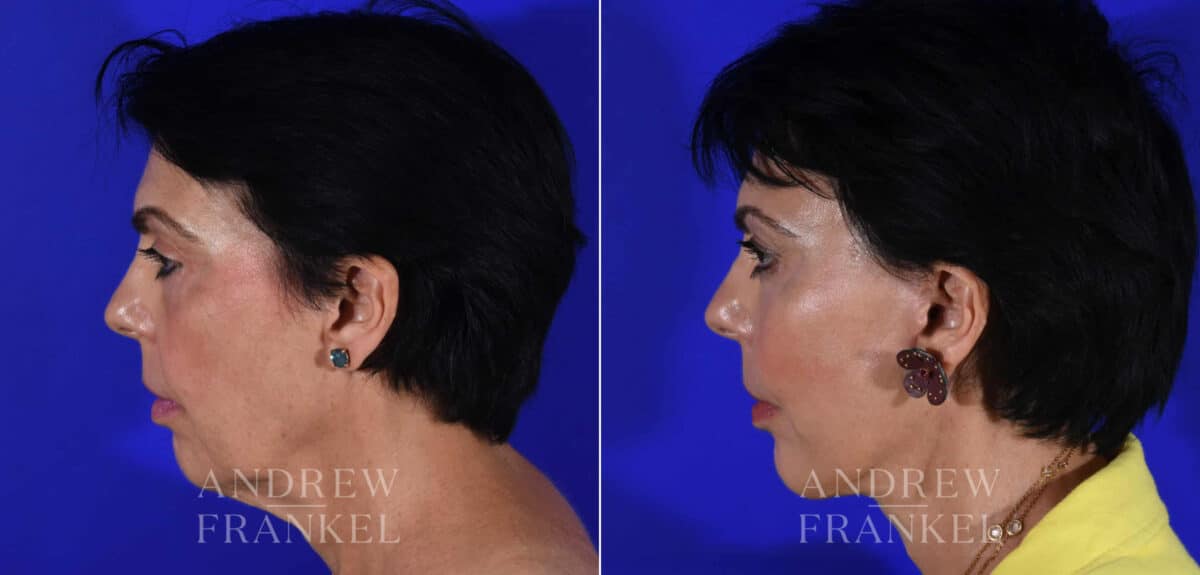 Facial Rejuvenation before and after photos in Beverly Hills, CA, Patient 22377