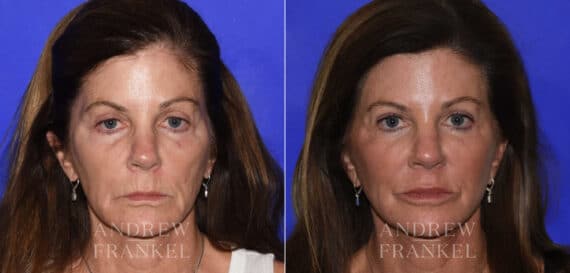 Midface Lift before and after photos in Beverly Hills, CA, Patient 22393