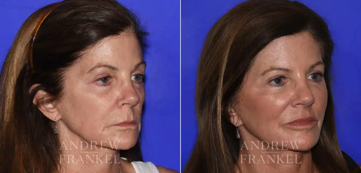 Midface Lift before and after photos in Beverly Hills, CA, Patient 22393
