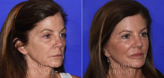 Midface Lift before and after photos in Beverly Hills, CA, Patient 22393