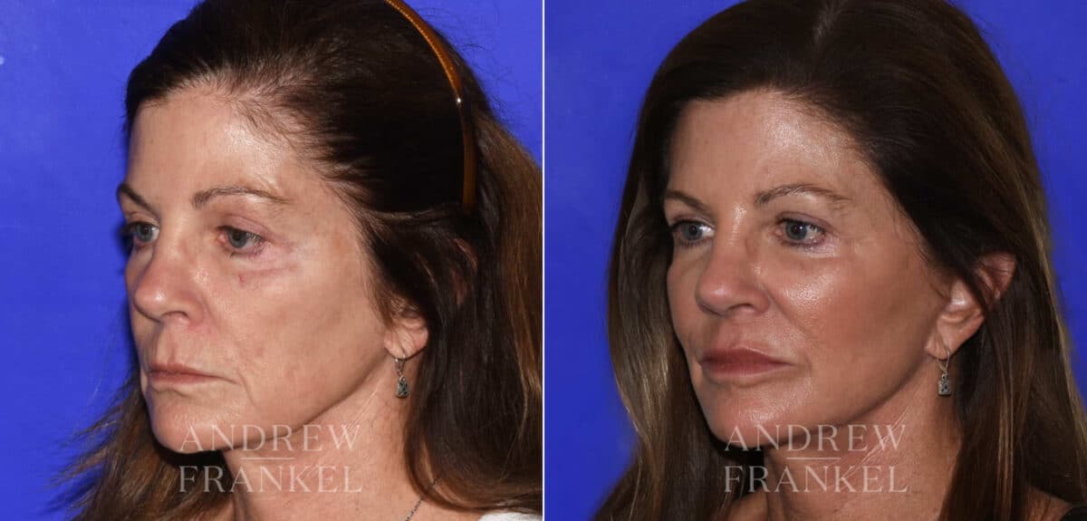 Midface Lift before and after photos in Beverly Hills, CA, Patient 22393