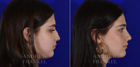 Rhinoplasty before and after photos in Beverly Hills, CA, Patient 22403