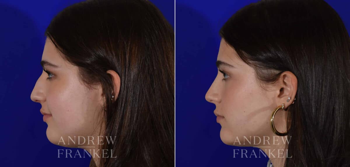 Rhinoplasty before and after photos in Beverly Hills, CA, Patient 22403
