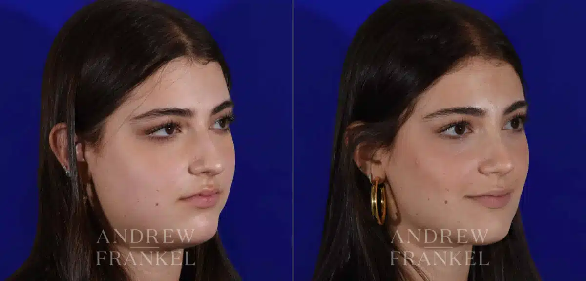 Rhinoplasty before and after photos in Beverly Hills, CA, Patient 22403