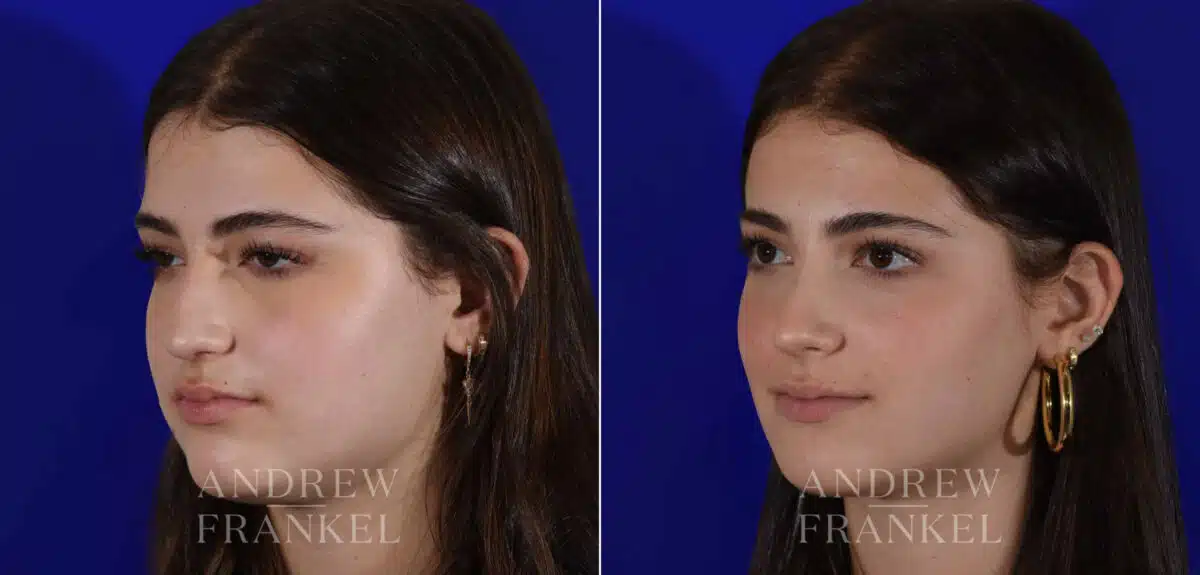 Rhinoplasty before and after photos in Beverly Hills, CA, Patient 22403