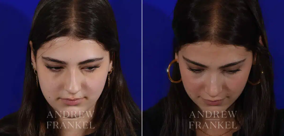 Rhinoplasty before and after photos in Beverly Hills, CA, Patient 22403