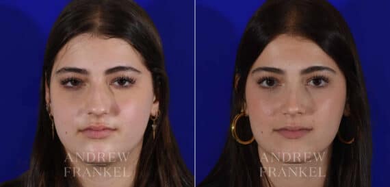 Rhinoplasty before and after photos in Beverly Hills, CA, Patient 22403