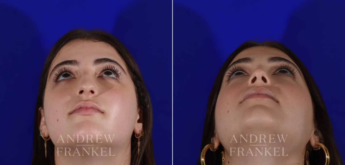 Rhinoplasty before and after photos in Beverly Hills, CA, Patient 22403