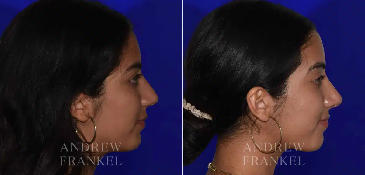 Rhinoplasty before and after photos in Beverly Hills, CA, Patient 22438
