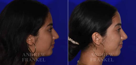 Rhinoplasty before and after photos in Beverly Hills, CA, Patient 22438