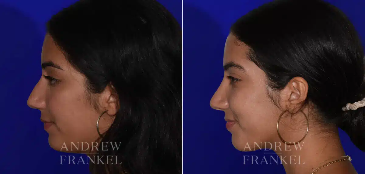 Rhinoplasty before and after photos in Beverly Hills, CA, Patient 22438