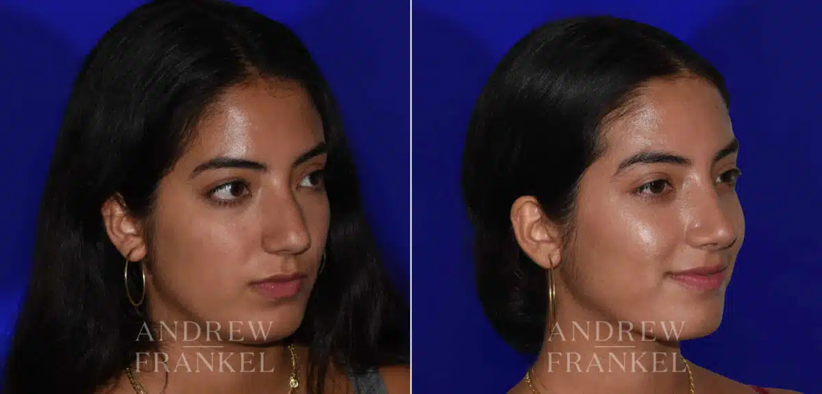 Rhinoplasty before and after photos in Beverly Hills, CA, Patient 22438