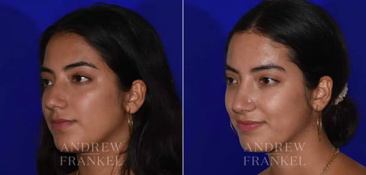 Rhinoplasty before and after photos in Beverly Hills, CA, Patient 22438