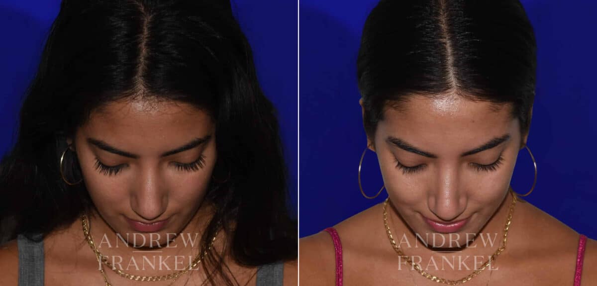 Rhinoplasty before and after photos in Beverly Hills, CA, Patient 22438