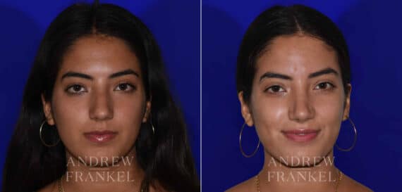 Rhinoplasty before and after photos in Beverly Hills, CA, Patient 22438