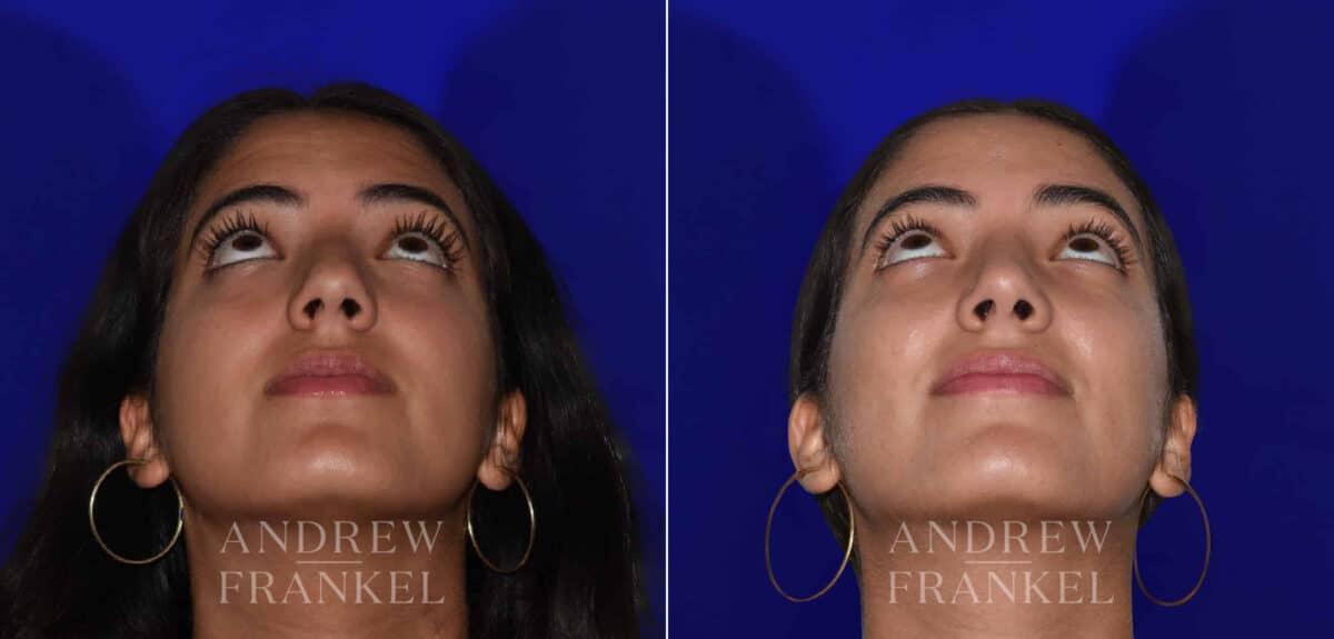 Rhinoplasty before and after photos in Beverly Hills, CA, Patient 22438