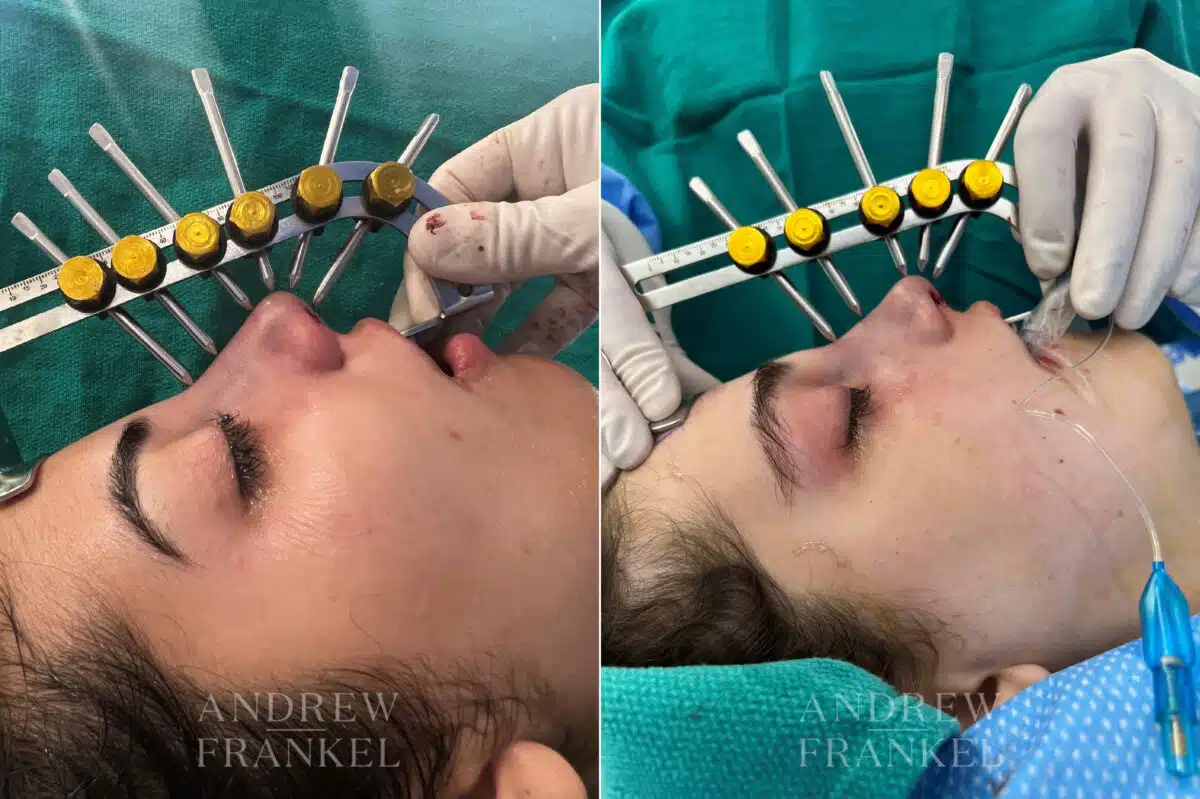 Rhinoplasty before and after photos in Beverly Hills, CA, Patient 22438