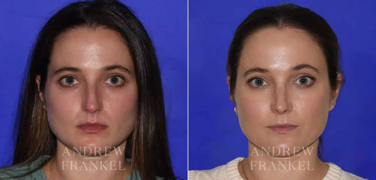 Rhinoplasty before and after photos in Beverly Hills, CA, Patient 22479
