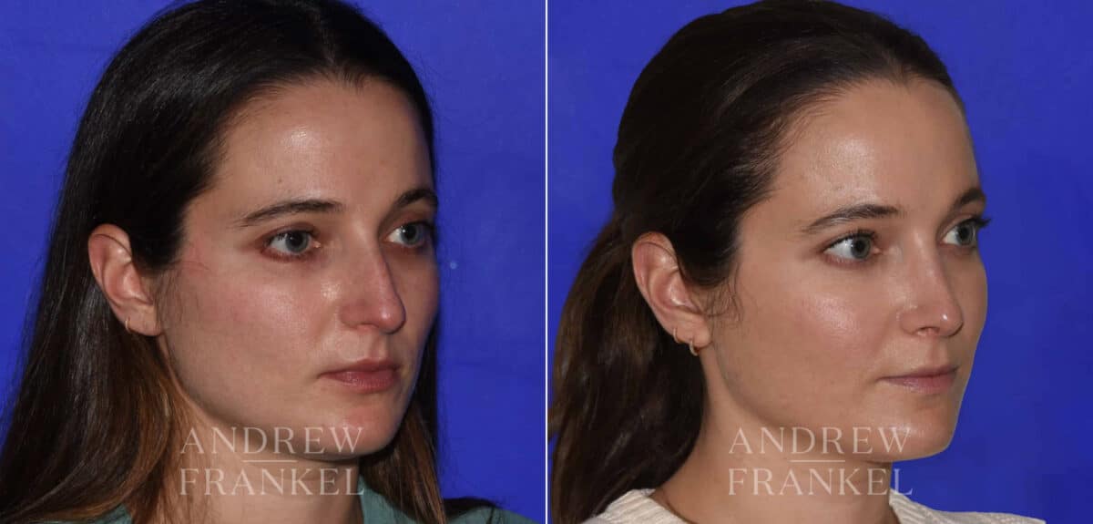 Rhinoplasty before and after photos in Beverly Hills, CA, Patient 22479