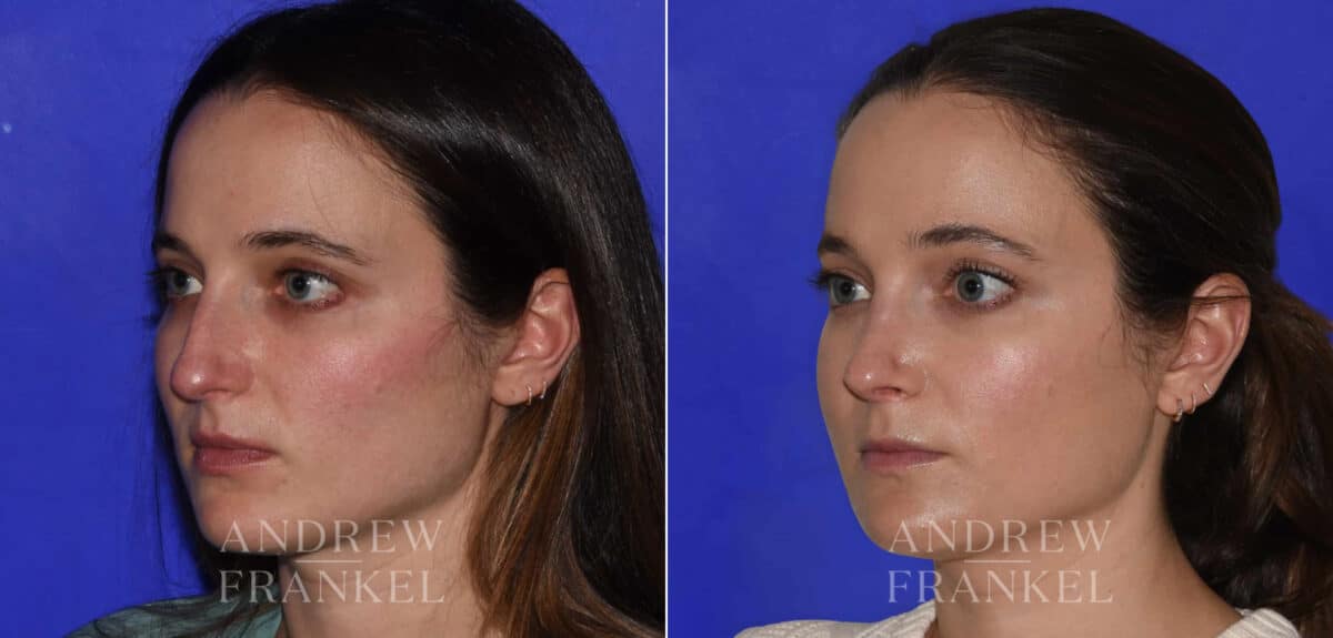 Rhinoplasty before and after photos in Beverly Hills, CA, Patient 22479