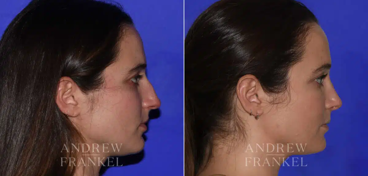 Rhinoplasty before and after photos in Beverly Hills, CA, Patient 22479