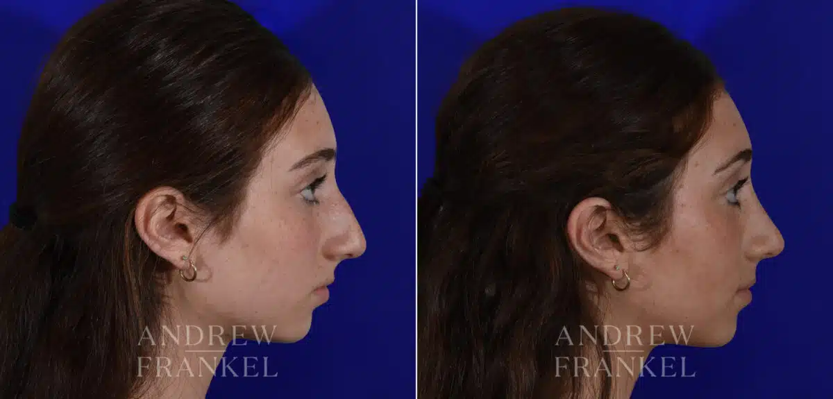 Rhinoplasty before and after photos in Beverly Hills, CA, Patient 22505