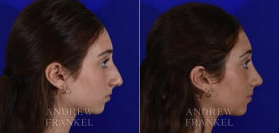 Rhinoplasty before and after photos in Beverly Hills, CA, Patient 22505
