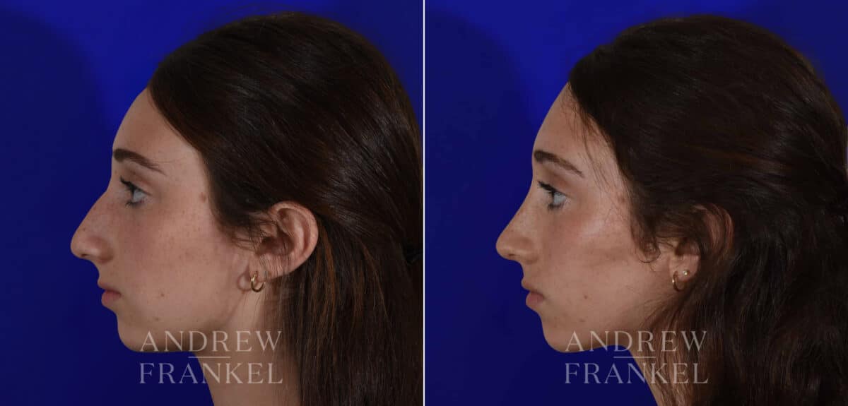 Rhinoplasty before and after photos in Beverly Hills, CA, Patient 22505