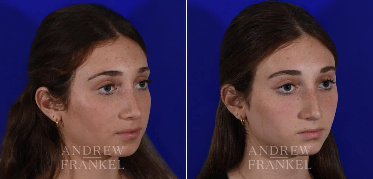 Rhinoplasty before and after photos in Beverly Hills, CA, Patient 22505