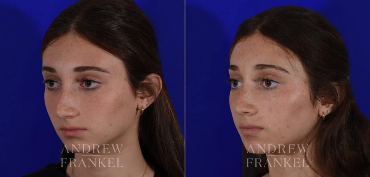 Rhinoplasty before and after photos in Beverly Hills, CA, Patient 22505