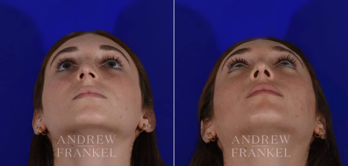 Rhinoplasty before and after photos in Beverly Hills, CA, Patient 22505